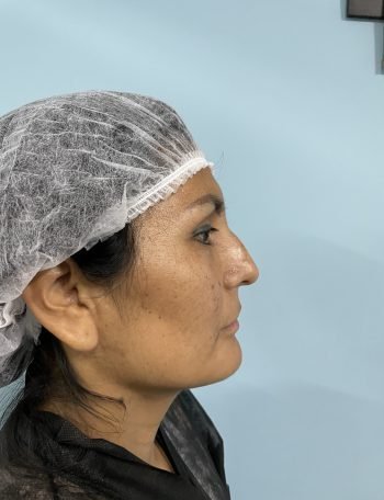Fotos preoperatorias de una Rinoplastía | Foto 2