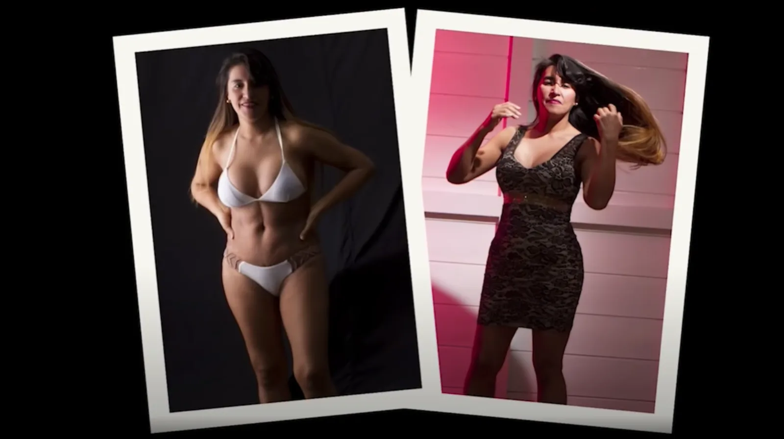 Fotos pre-operación de una Abdominoplastia