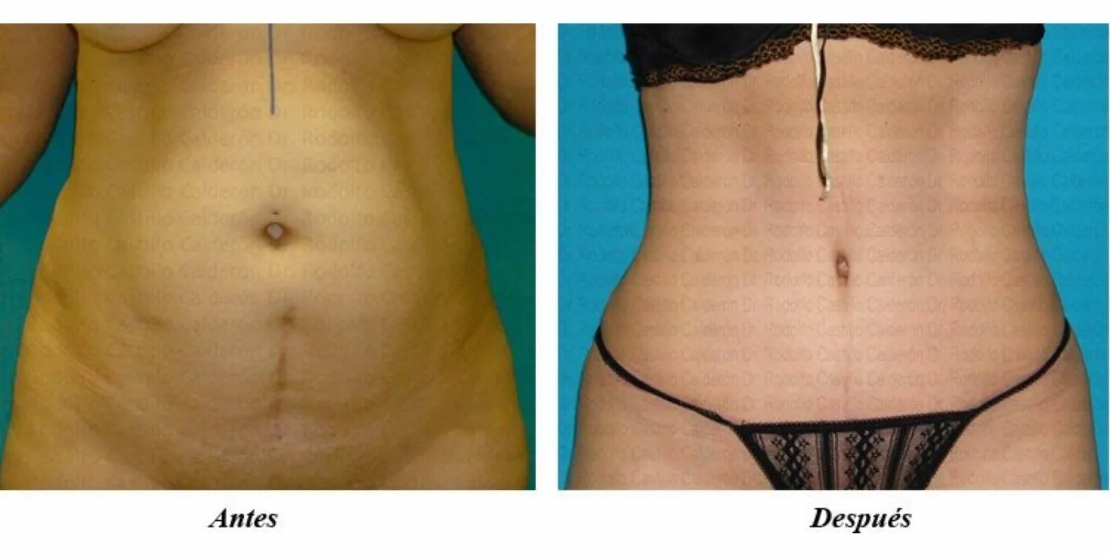 Antes y después de Abdominoplastia