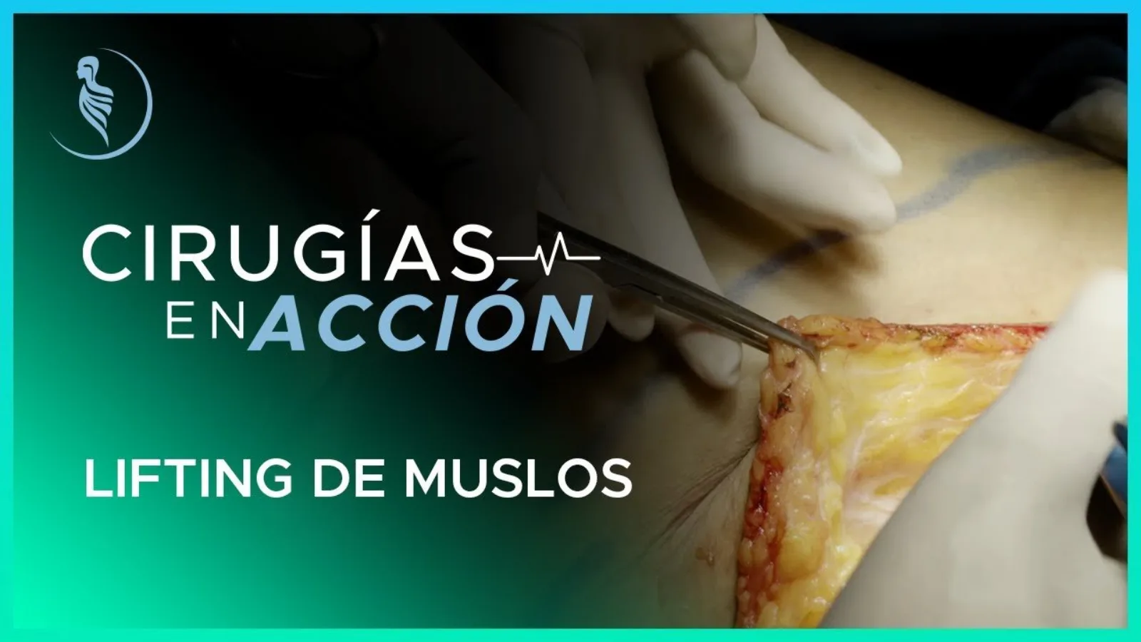 accion-14