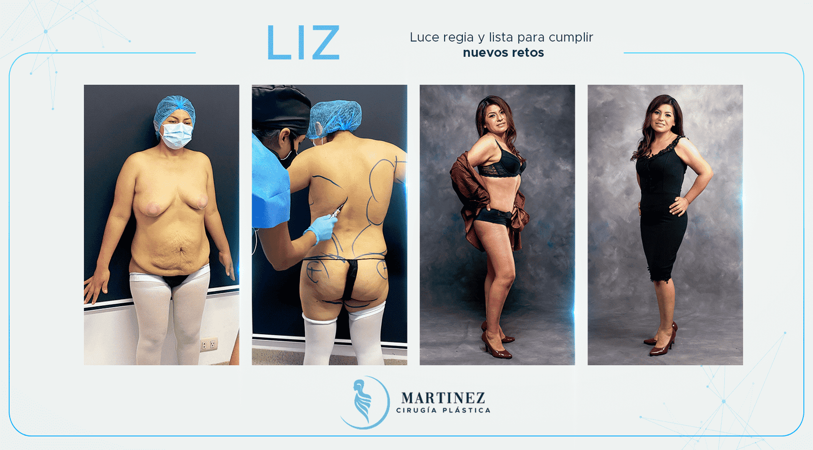 Antes y después — paciente Liz