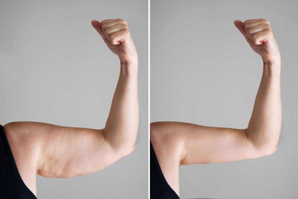 Obesity,Cellulite,And,Fat,Removal,Surgery,Before,And,After