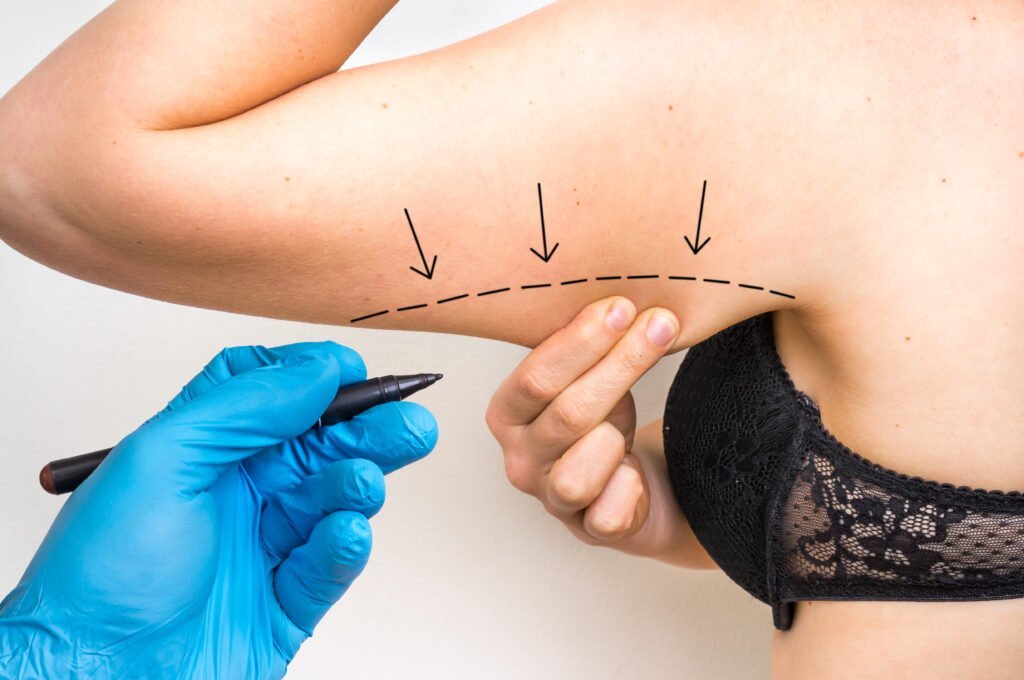 Plastic,Surgery,Doctor,Draw,Line,On,Patient,Arm,-,Cosmetic