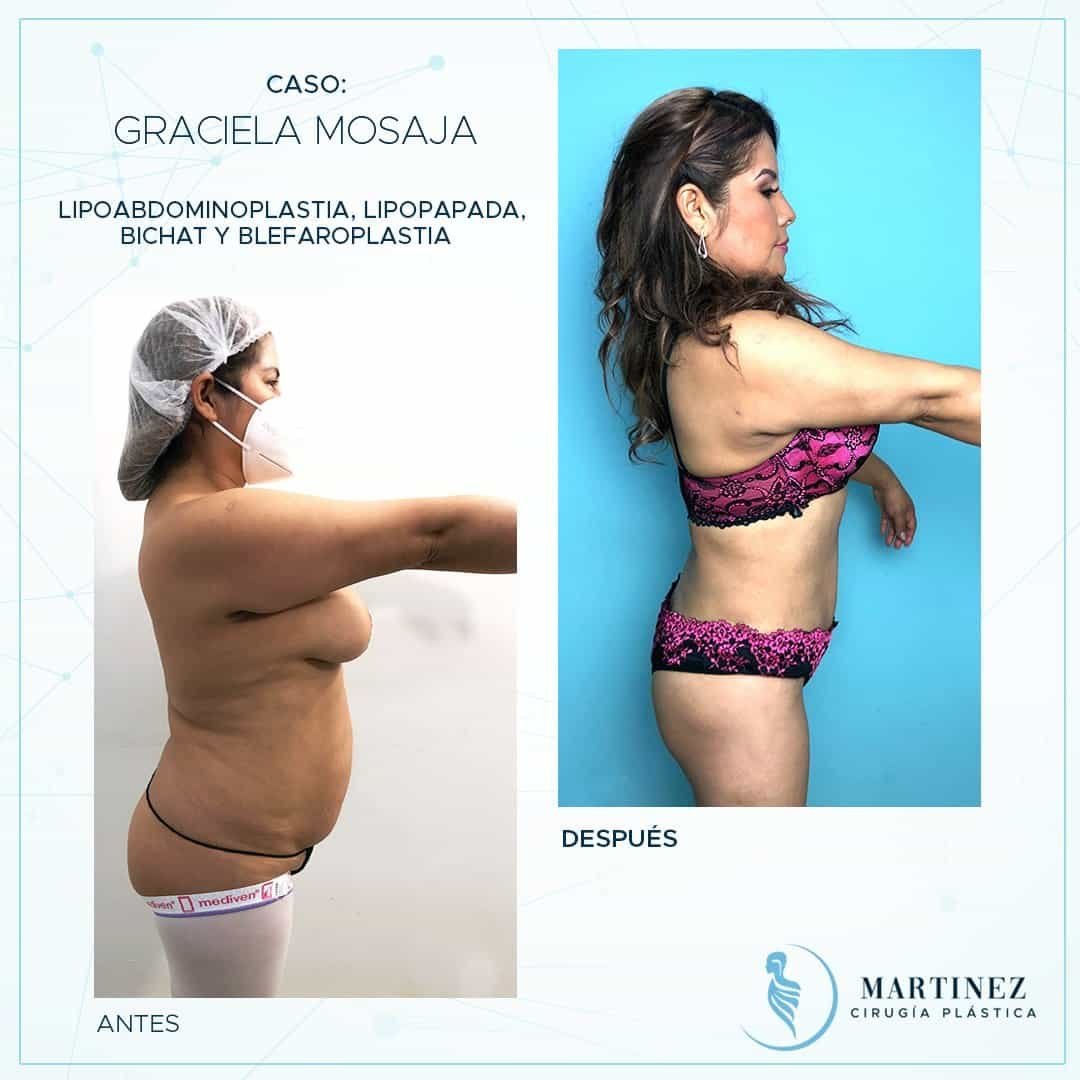 Caso real — Graciela