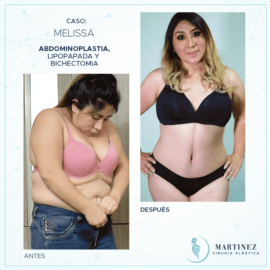 Caso real — Melissa