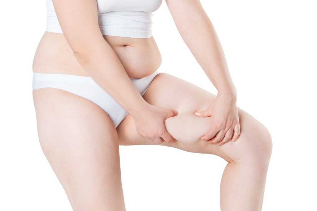 Overweight,Woman,With,Fat,Thighs,,Obesity,Female,Legs,Isolated,On