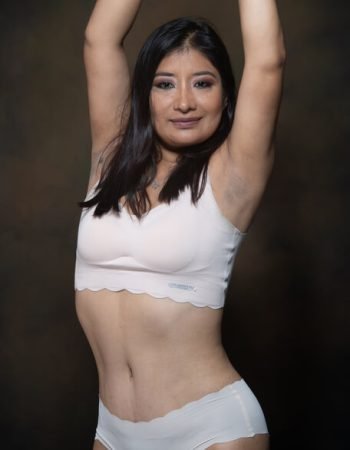 Después — Abdominoplastía