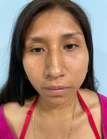 Antes — Rinoplastía