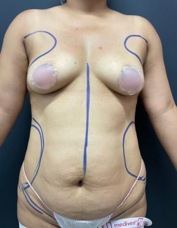 Antes — Abdominoplastía