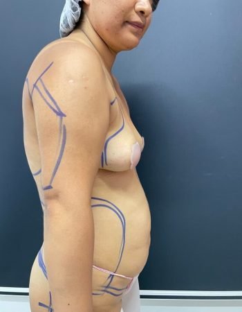 Antes — Abdominoplastía