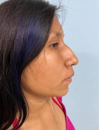 Antes — Rinoplastía