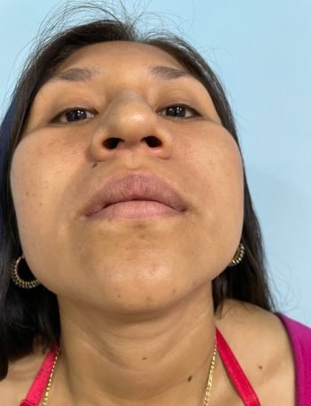 Antes — Rinoplastía