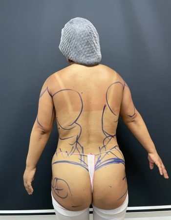 Antes — Abdominoplastía