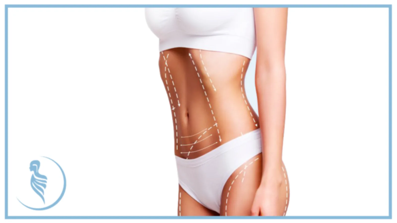 Qué es la Abdominoplastía